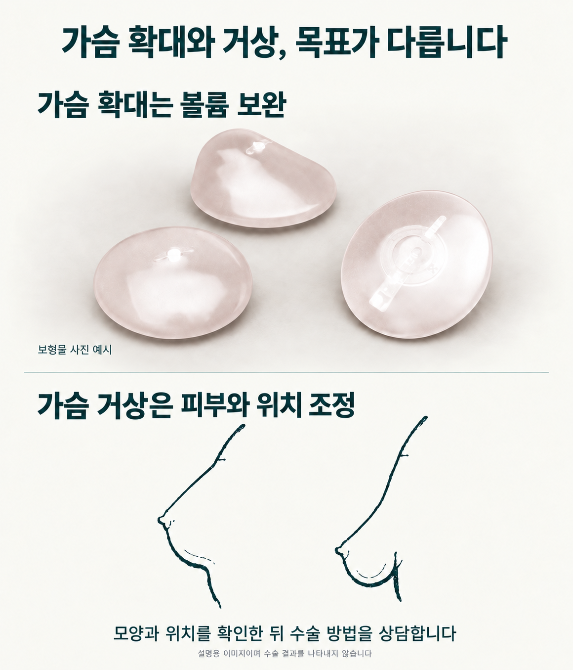가슴 확대의 볼륨 보완과 가슴 거상의 피부 및 위치 조정